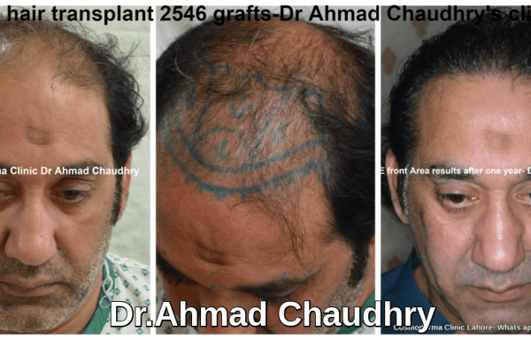 Best-hair-transplant-clinic-Lahore