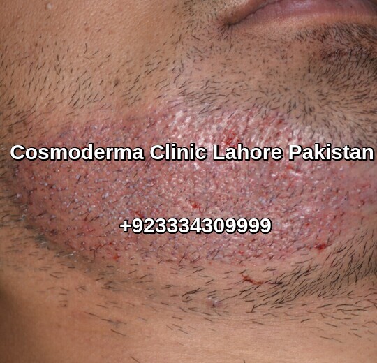 Facial hair restoration procedure in Lahore Pakistan