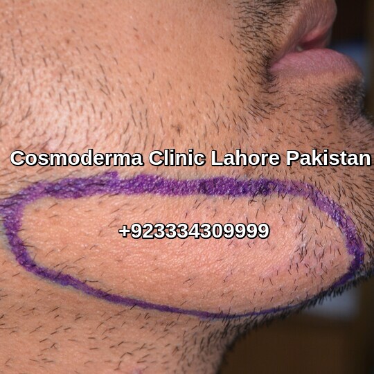 Facial hair transplant clinic Lahore Pakistan