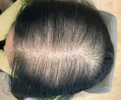 Female hair thinning