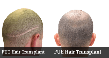 Follicular-hair-transplant-FUT-in-Lahore-Pakistan-1