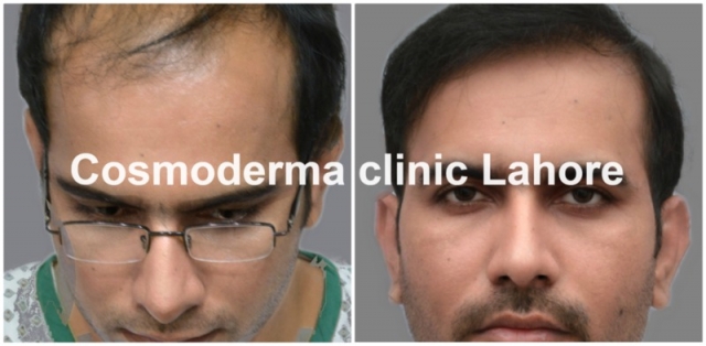 Front-hairline-clinic-lahore-Pakista