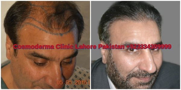 Fue-hair-transplant-clinic-lahore-results-3000-grafts