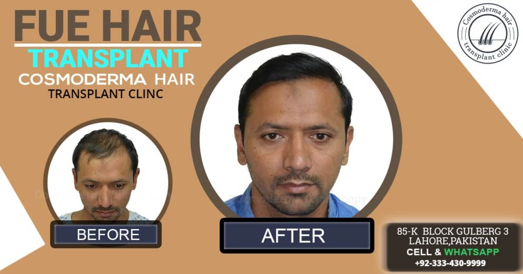 Fue-hair-transplant-in-Lahore