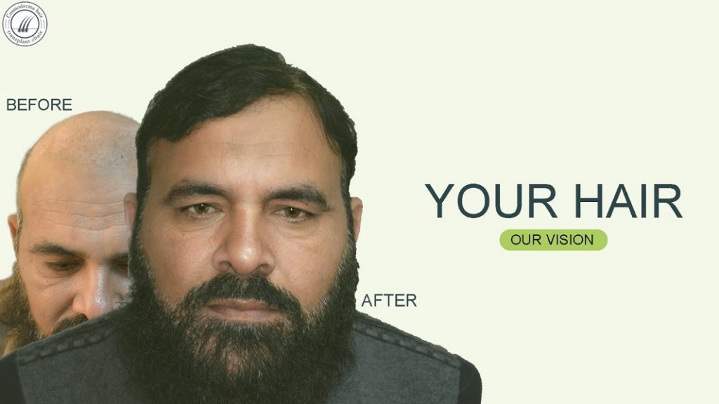 fue-hair-transplant-Lahore-pakistan