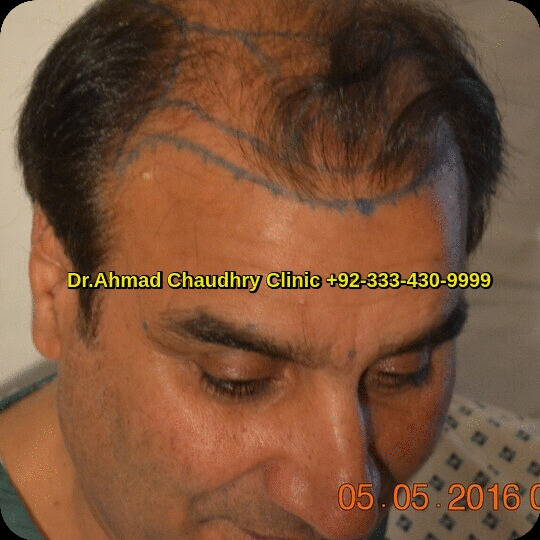 hair transplant before procedure photos