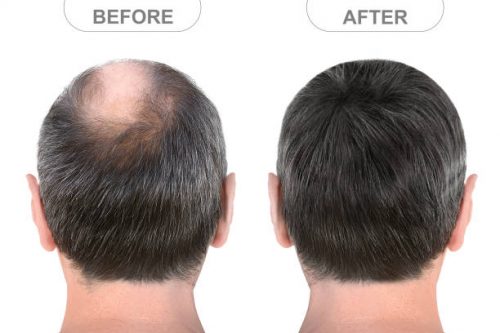 Cheap hair transplant Perth Australia