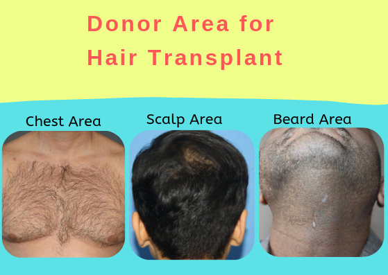 Does body hair transplant work
