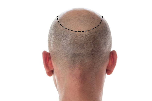 Hair transplant Los Angeles USA