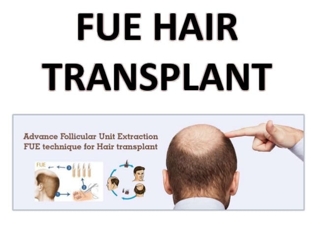 Hair transplant Malaysia