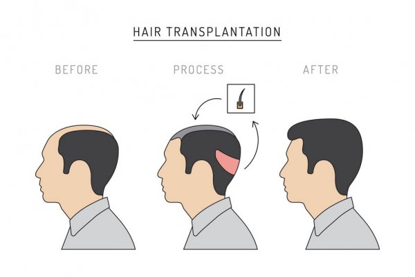 Hair transplant cost Sweden