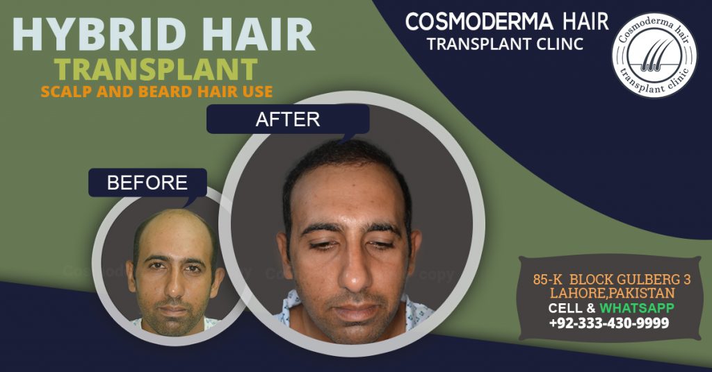 Beard body hair for head hair transplant in Lahore