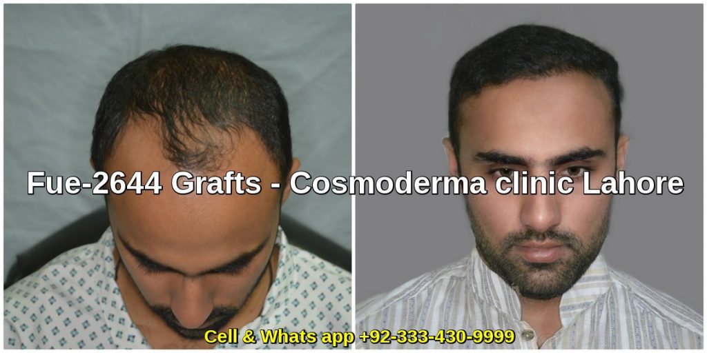 Fue 2644 grafts hair transplant results 6 months later results Lahore