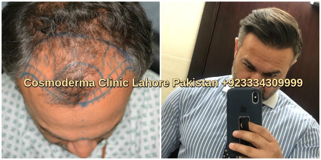 Fue hair restoration Doha patient