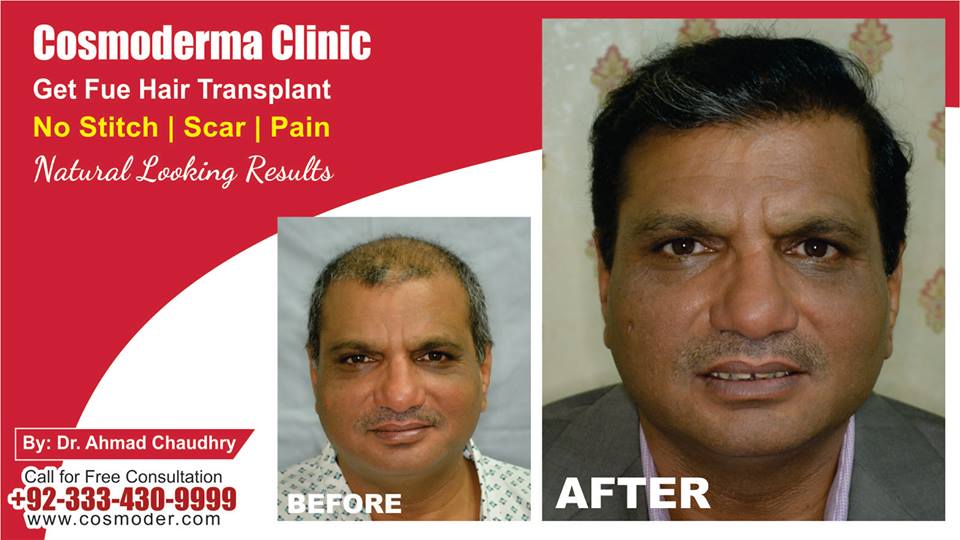 Hair transplant surgery clinic in Lahore Pakistan