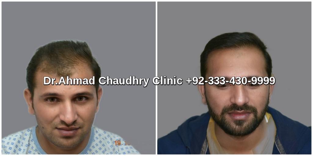 Fue hair transplant in Lahore 3000 grafts result