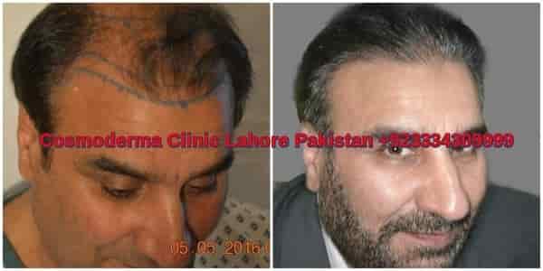 Right view after hair transplant results