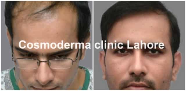 Front-hairline-clinic-lahore