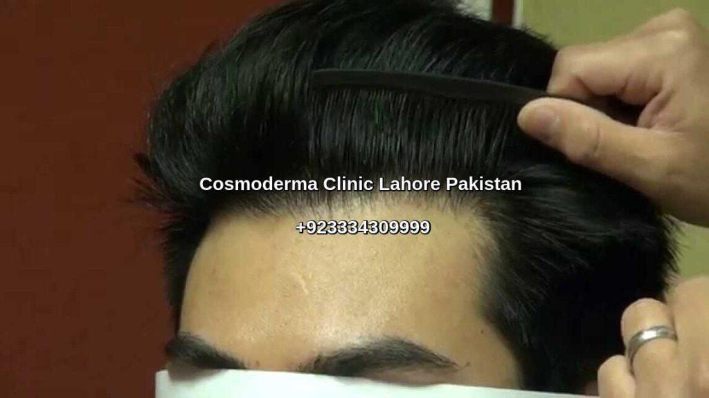 Hairline hair transplant Lahore