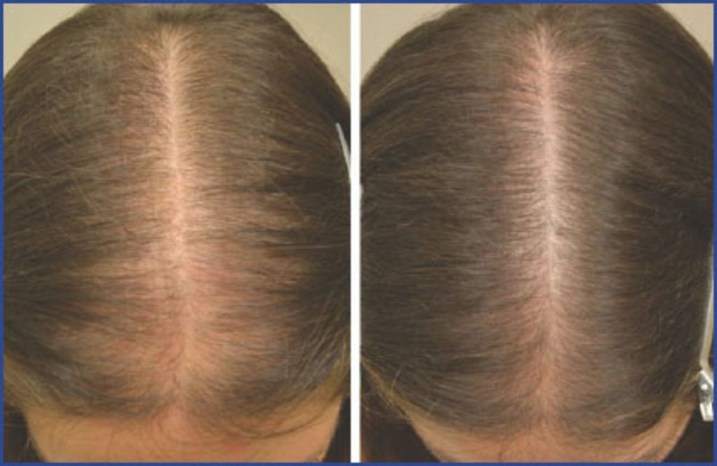 Female hair loss treatment in Lahore Hair fall treatment Free checkup