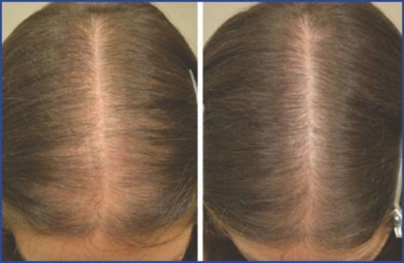 Female pattern baldness treatment Lahore