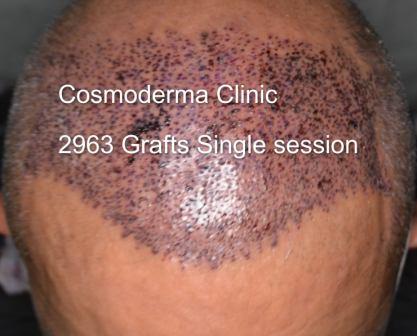 Male pattern baldness treatment clinic Lahore