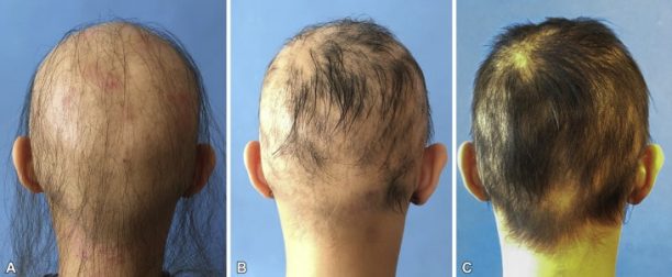 New treatment for alopecia