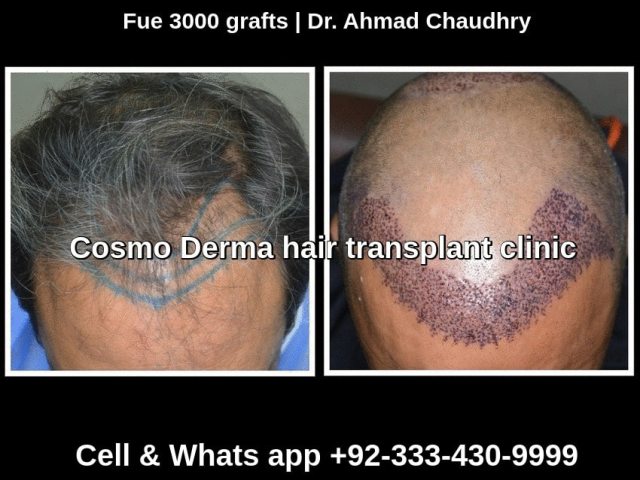 Hair transplant Pakistan before after