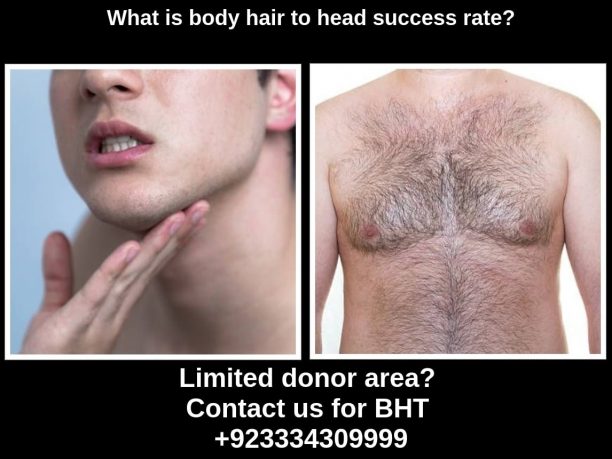 Body hair transplant success rate
