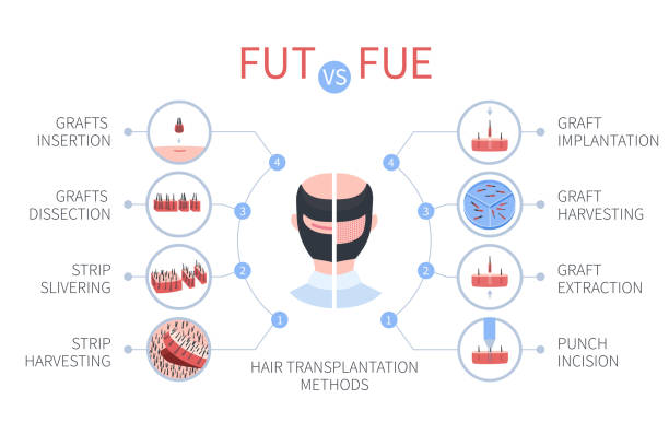 Fue Fut hair restoration cost Sweden