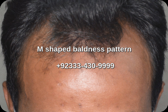 M shape male pattern baldness