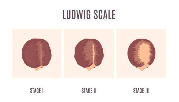 Female hair loss Ludwig classification