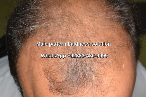 male pattern baldness solution