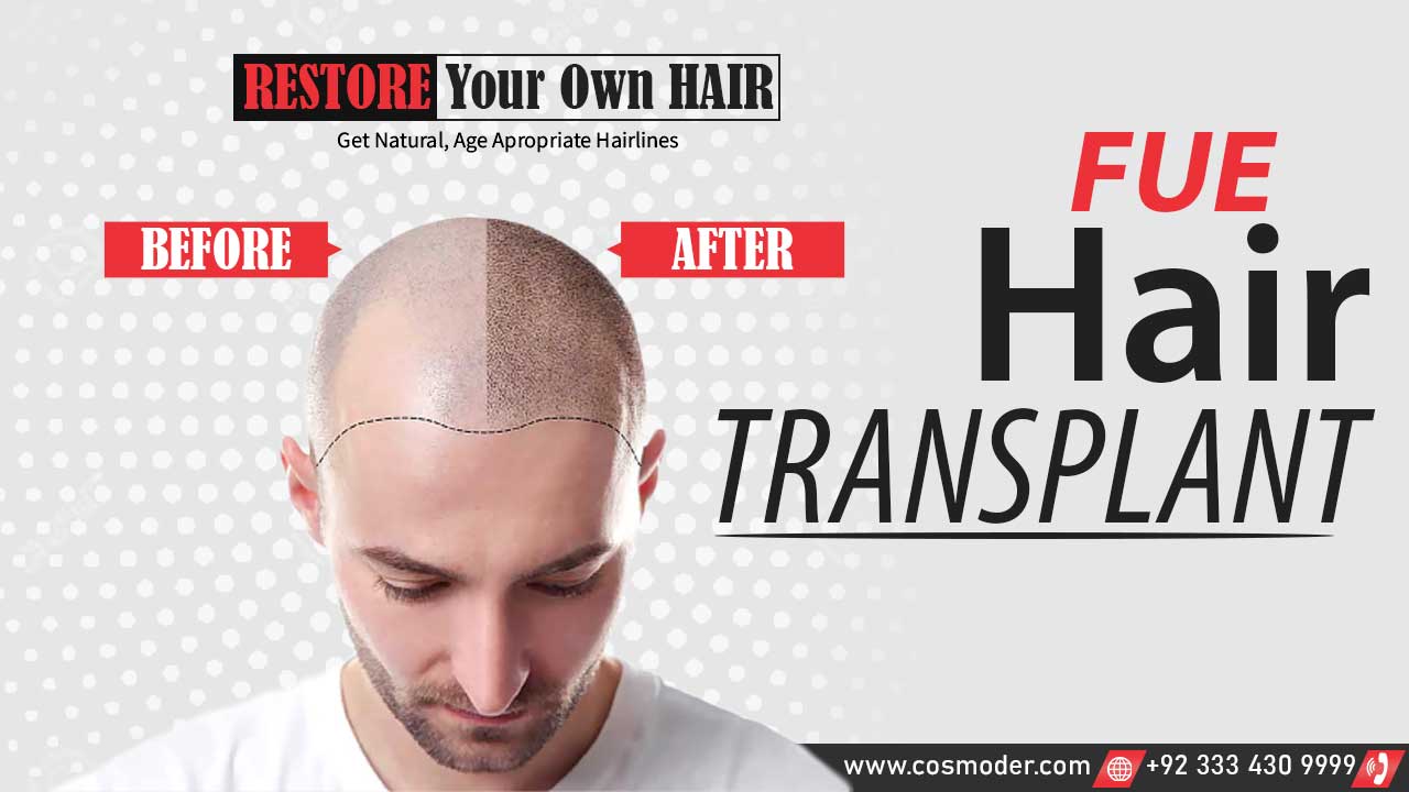 hair transplant in Pakistan