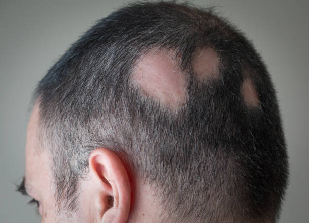 Male alopecia areata Lahore Pakistan