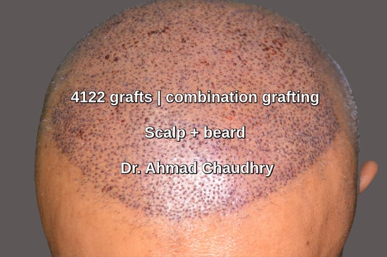 Scalp- beard grafts extraction Pakistan