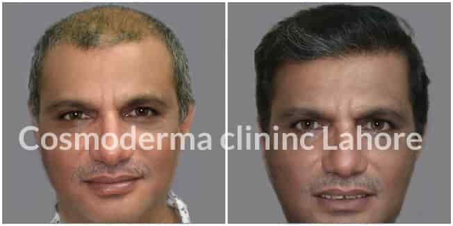 Top hair transplant results Lahore