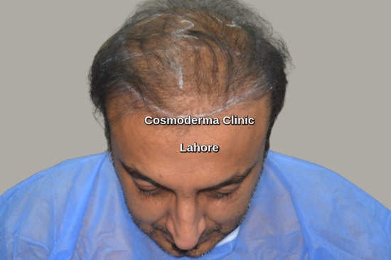 poor hair transplant results Gujrat Pakistan