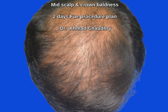 Baldness Perth patient