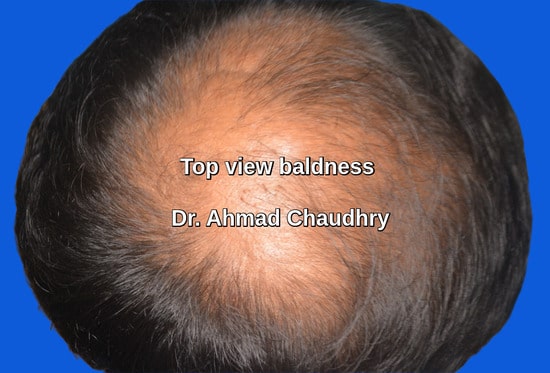 Top view bald area before treatment