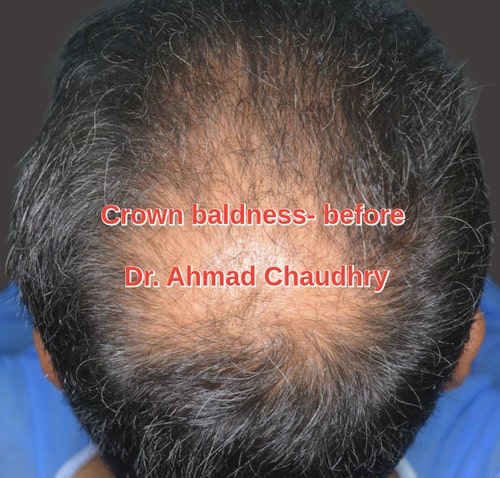 Crown Baldness treatment NYC