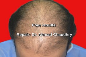 Botched hair transplant fixing Lahore