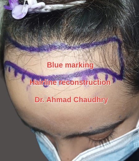 Female hairline lowering Lahore Pakistan