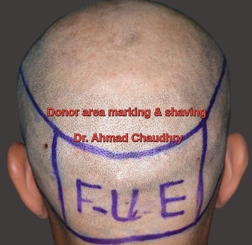 Donor area marking before Fue procedure