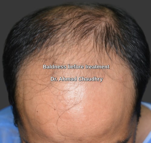 Hair loss Pasrur patient