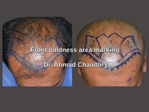 Pakistan best Fue hair transplant clinic patient