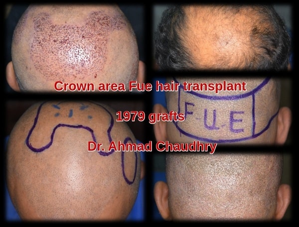 Transplant hair Lahore patient