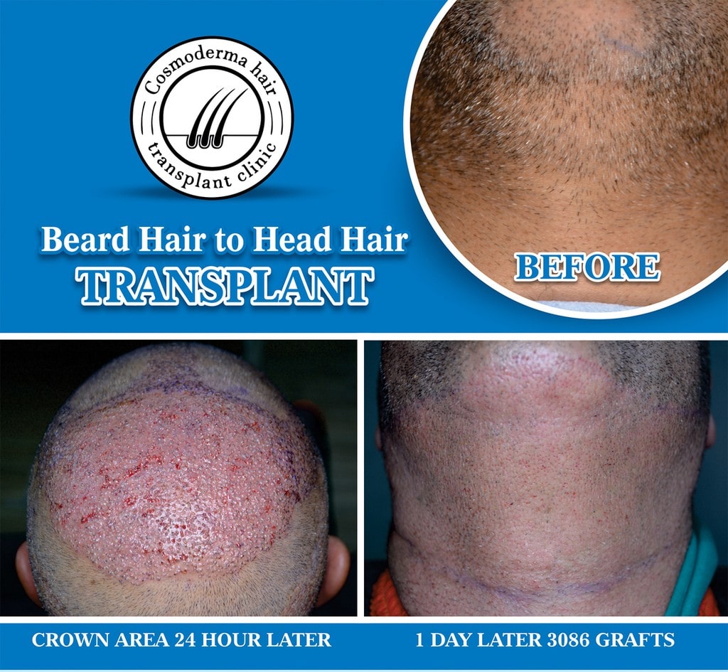 Beard hair transfer to head Lahore