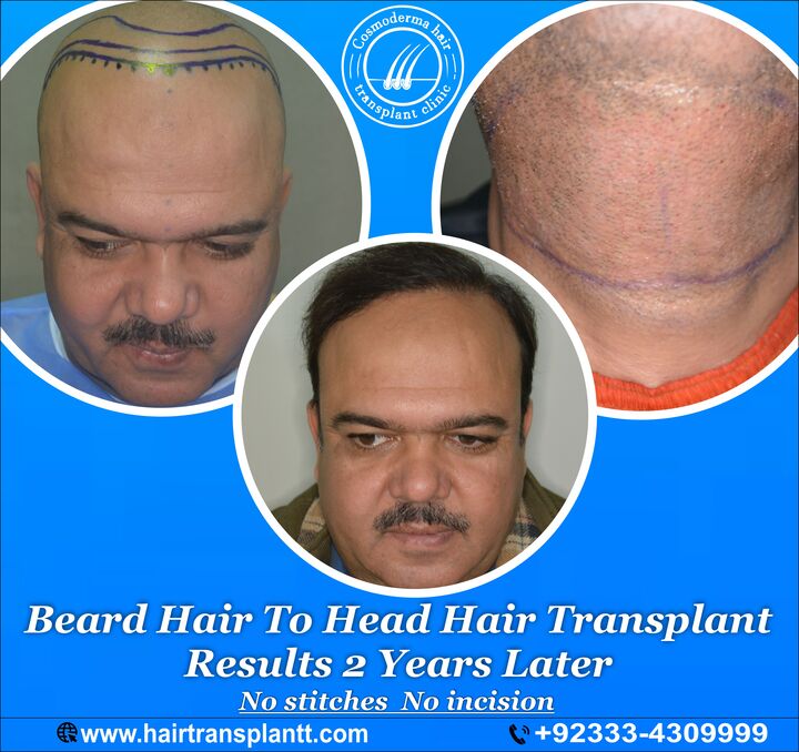 hair restoration clinic Lahore result